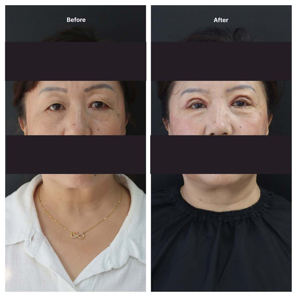 Eyelid Surgery KOQ10